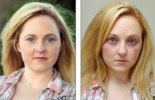 哭能致命！ 英國女子皮膚對水嚴(yán)重過敏不敢流淚